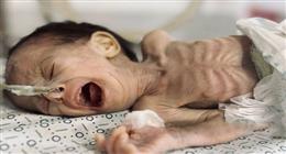 استشهاد 89 طفلا بسبب المجاعة في غزة