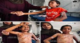 طفح جلدي يهاجم جسد «فاطمة» والتشخيص مجهول.. مأساة جديدة لأطفال غزة