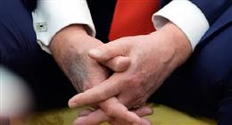 حقيقة وفاة دونالد ترامب.. قصة «كدمة» أثارت جدلًا واسعًا حول العالم