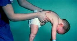 تحليل وقائي ينقذ الأطفال من مرض ضمور العضلات.. سعره يقارب الـ5 آلاف جنيه