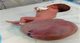 مأساة طفلة فلسطينية تولد بورم نادر.. الحرب والسموم تهزم الطب في غزة