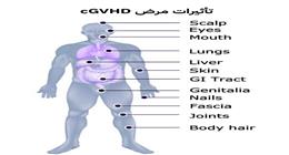ما بعد زراعة النخاع العظمي؟ .. في ضوء اليوم العالمي لمرضى الطرد العكسي ضد النخاع