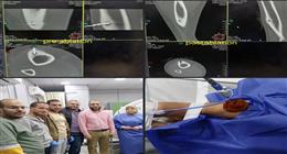 نجاح عملية كي حراري لعلاج ورم عظمي بمستشفيات جامعة بني سويف