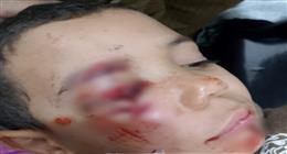 طفل في أشمون يتعرض لعقر كلب.. ويصيب عينه بإصابة بالغة