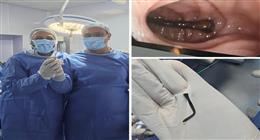 استخراج مسمار طوله 5 سنتيمترات من الأمعاء الدقيقة لطفل بالشرقية 