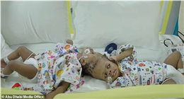 فصل توأم ملتصق من الرأس بمساعدة الذكاء الاصطناعي.. جراحة نادرة لمدة 12 ساعة